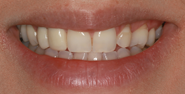 Before Image: Case 161 - front