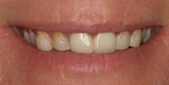 Before Image: Case 162 - front