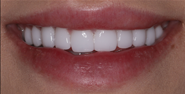 After Image: Case 163 - front
