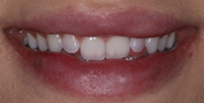 Before Image: Case 163 - front