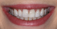 Before Image: Case 164 - front