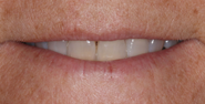 Before Image: Case 165 - front