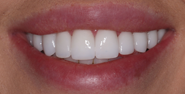 After Image: Case 166 - front