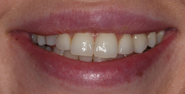 Before Image: Case 166 - front