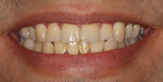 Before Image: Case 168 - front