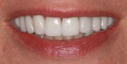 After Image: Case 169 - front