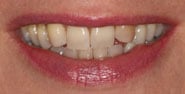 Before Image: Case 169 - front