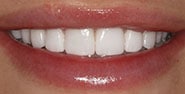 After Image: Case 174 - front
