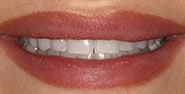 Before Image: Case 174 - front