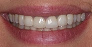 Before Image: Case 175 - front