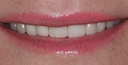 Before Image: Case 176 - front