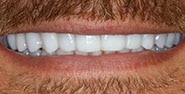 After Image: Case 177 - front