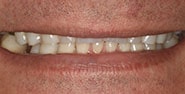 Before Image: Case 177 - front