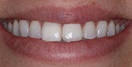 Before Image: Case 178 - front