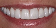 After Image: Case 179 - front