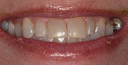Before Image: Case 179 - front