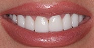 After Image: Case 180 - front