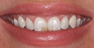Before Image: Case 180 - front