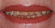 Before Image: Case 183 - front