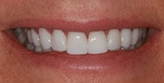 After Image: Case 184 - front