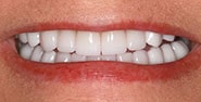 After Image: Case 185 - front