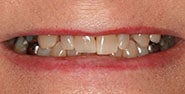 Before Image: Case 185 - front