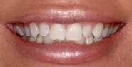 Before Image: Case 186 - front