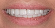 After Image: Case 187 - front