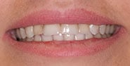 Before Image: Case 187 - front
