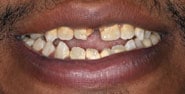 Before Image: Case 190 - front