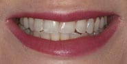 Before Image: Case 192 - front