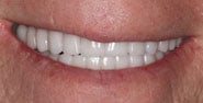 After Image: Case 194 - front