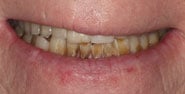 Before Image: Case 194 - front