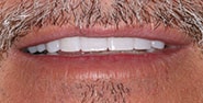After Image: Case 195 - front