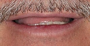 Before Image: Case 195 - front