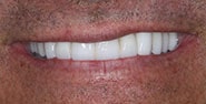 After Image: Case 196 - front