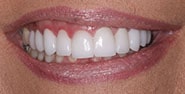 After Image: Case 197 - front