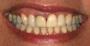 Before Image: Case 20 - front