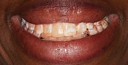Before Image: Case 201 - front