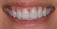After Image: Case 202 - front