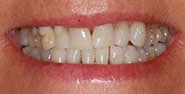 Before Image: Case 203 - front