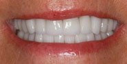 After Image: Case 204 - front