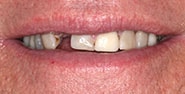 Before Image: Case 204 - front