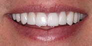After Image: Case 205 - front