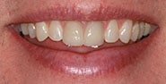 Before Image: Case 205 - front