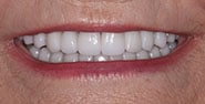 After Image: Case 206 - front