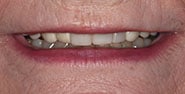 Before Image: Case 206 - front