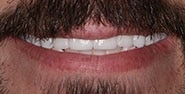 After Image: Case 207 - front