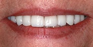 After Image: Case 208 - front