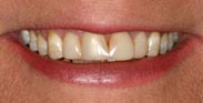 Before Image: Case 21 - front